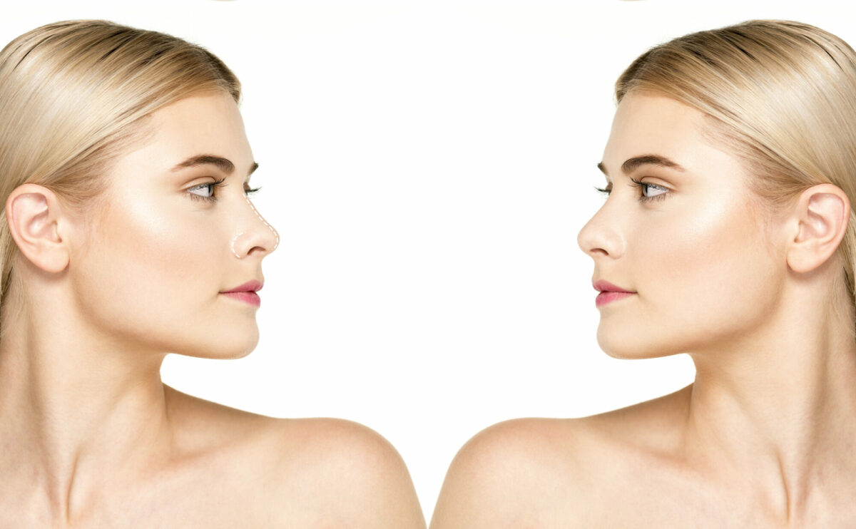 les injections au nez ou rhinoplastie médicale Clinique Rivoli Massena