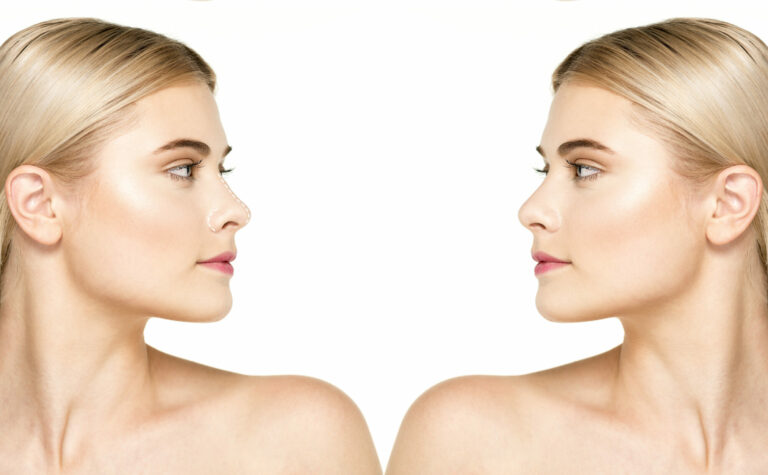 les injections au nez ou rhinoplastie médicale Clinique Rivoli Massena